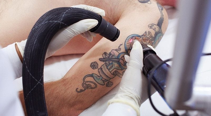 eliminar tatuajes con láser.