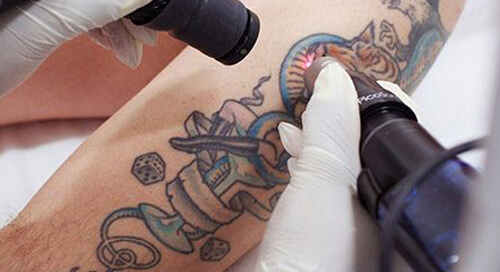 Eliminar tatuajes con láser: ¿realmente es efectiva esta técnica? 6
