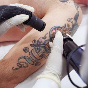 Eliminar tatuajes con láser: ¿realmente es efectiva esta técnica? 6